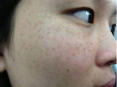 快速去除恼人斑点,恢复迷人容颜,逆龄15岁